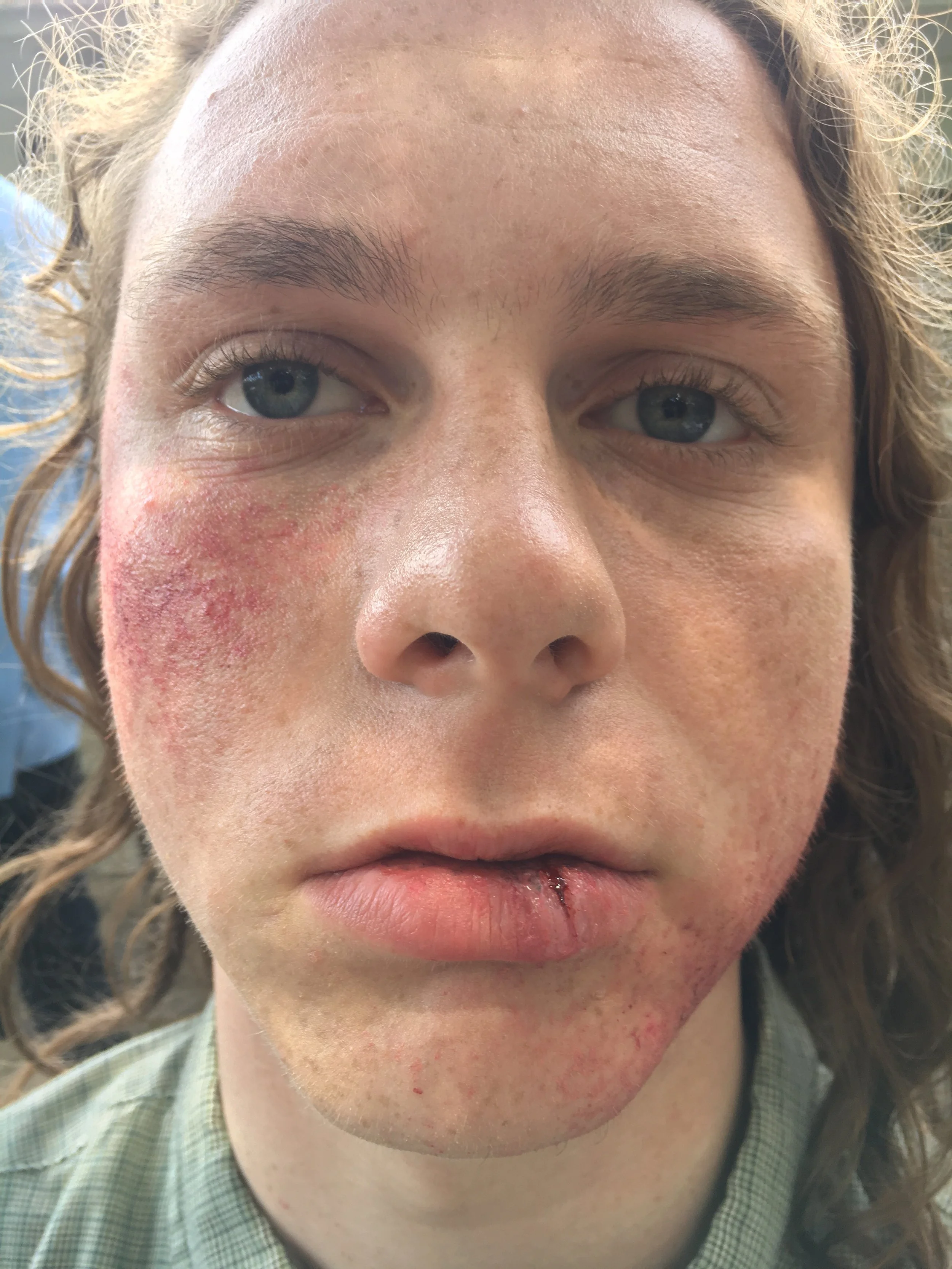 bruises &amp; split lip